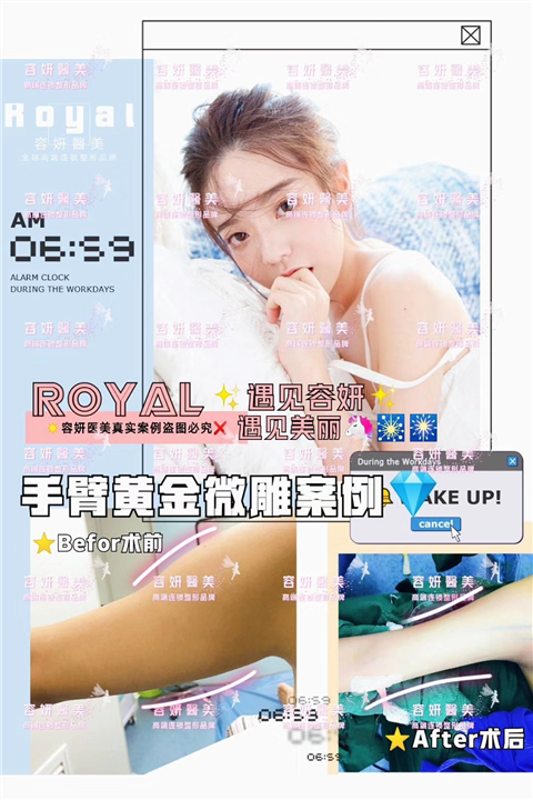 上海手臂吸脂整形 