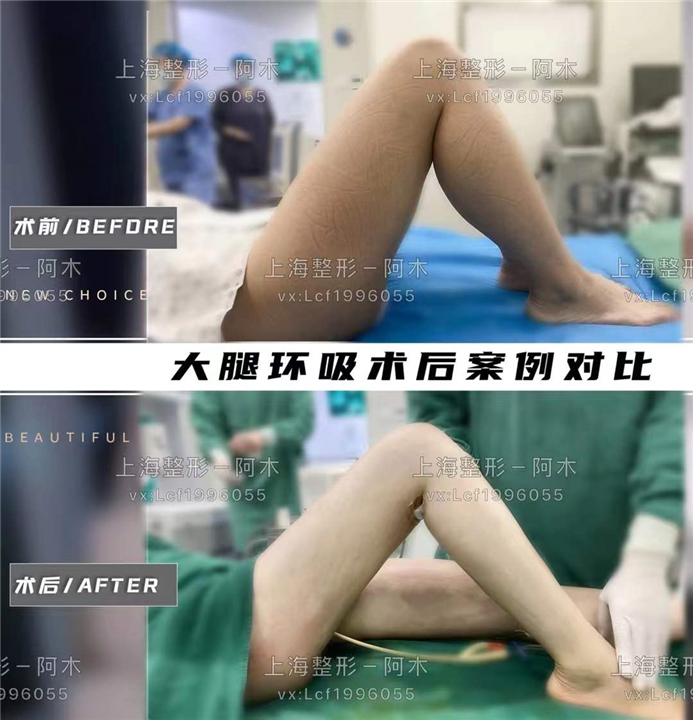 上海美丽之星大腿环吸