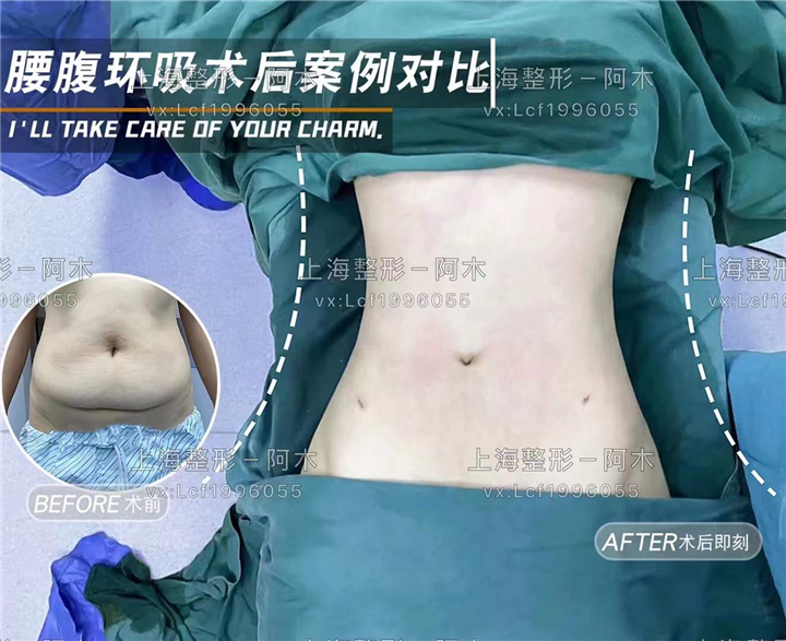 上海美丽之星整形腰腹环吸术后案例