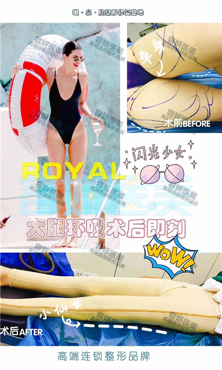 上海大腿吸脂价格 