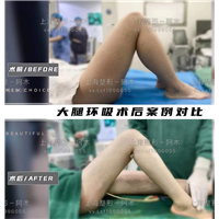 上海美丽之星大腿环吸