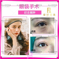 上海芭比眼整形 