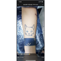 石狮激光洗纹身 