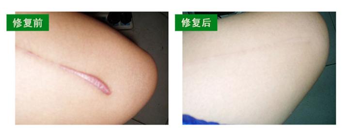 青海去除疤痕哪里**