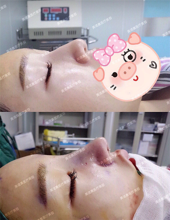 成都美诺晨医疗美容鼻整形项目