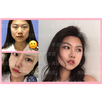 成都面部脂肪填充成功案例分享