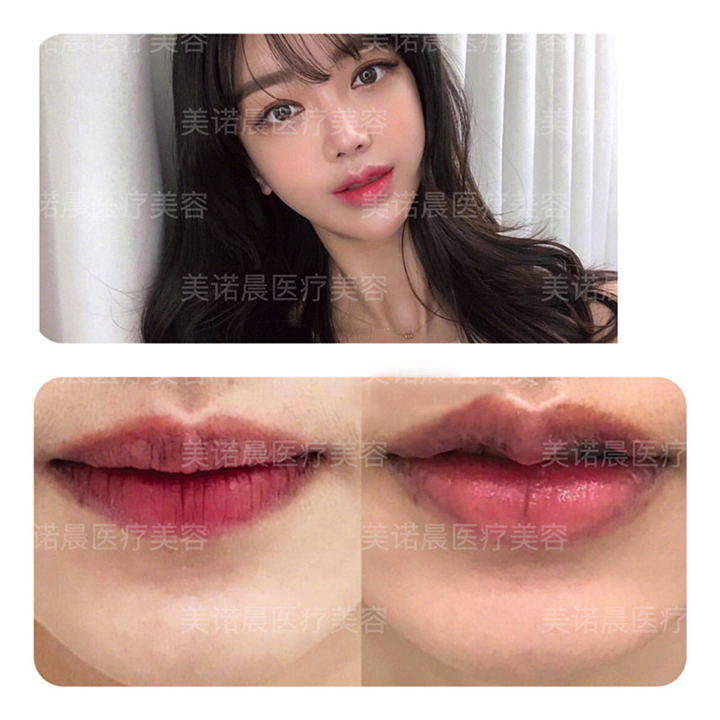 成都美诺晨M唇整形