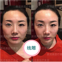 成都美诺晨线雕提升项目
