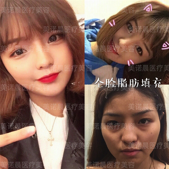 成都自体脂肪面部填充多少钱