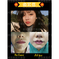 成都美诺晨唇部整形