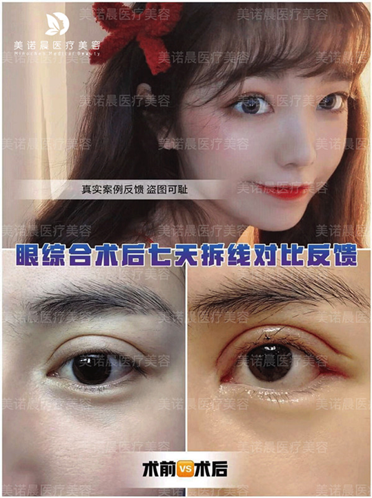 成都美诺晨整形眼综合术后七天拆线