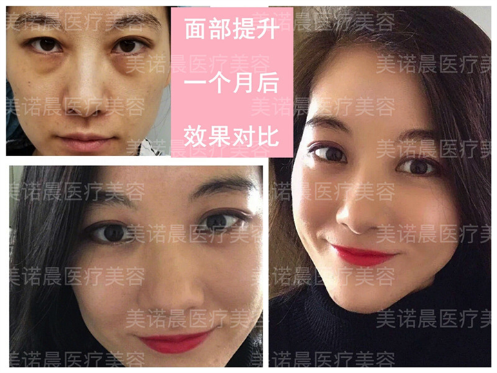 成都美诺晨做线雕怎么样