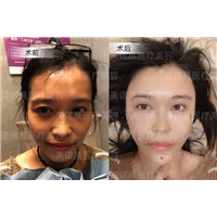 成都做面部脂肪填充的哪家好