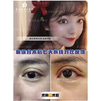 成都美诺晨整形眼综合术后七天拆线