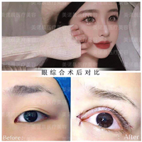 成都美诺晨眼综合术后对比
