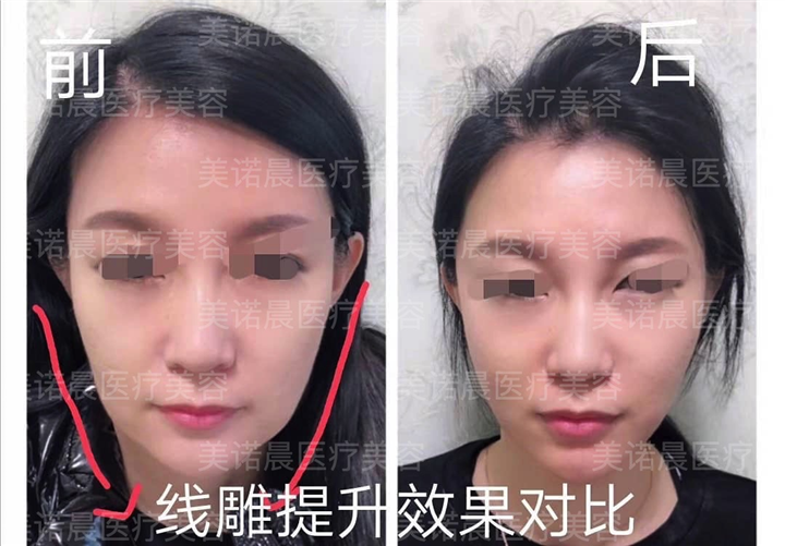 成都美诺晨线雕提升效果对比