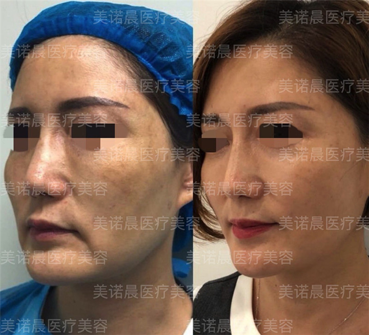 成都线雕整形