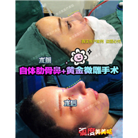 成都美诺晨鼻子做的怎么样