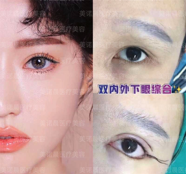 成都美诺晨眼综合整形