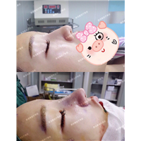 成都美诺晨医疗美容鼻整形项目