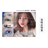 成都美诺晨双眼皮修复