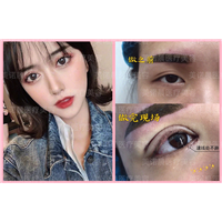 成都美诺晨眼综合整形术后对比