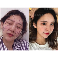 成都美诺晨自体脂肪面部填充