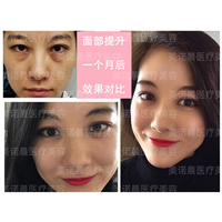 成都美诺晨做线雕怎么样