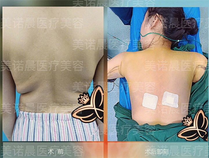 成都做抽脂整形哪家好