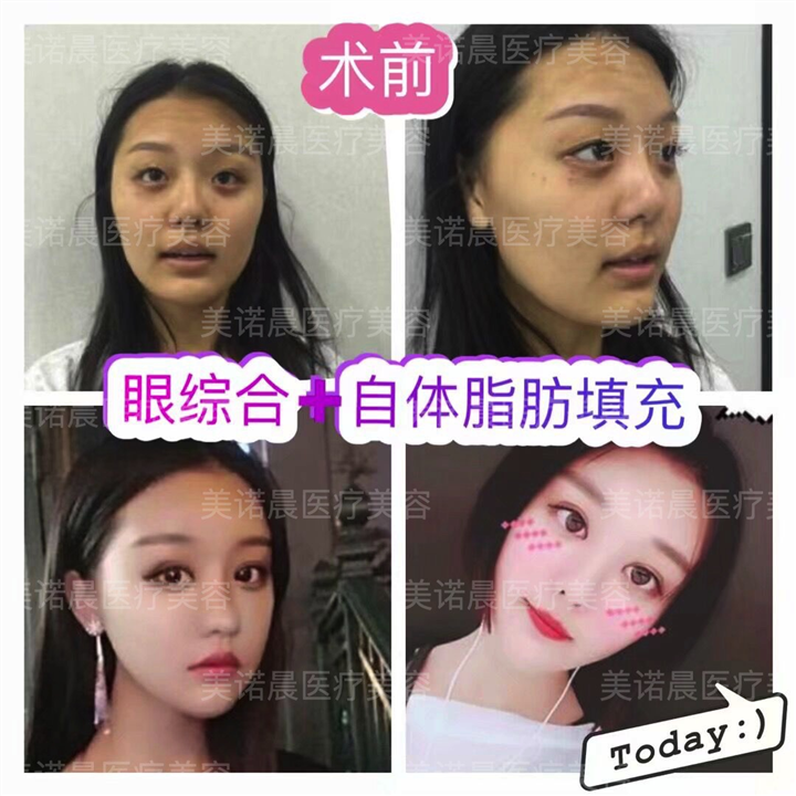眼综合+自体脂肪填充