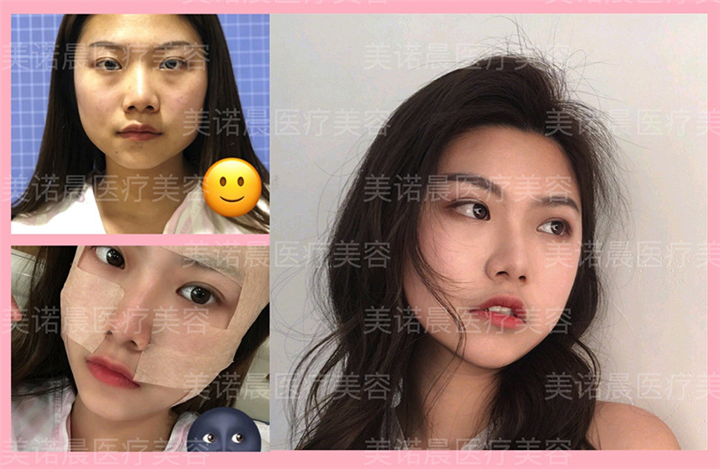 成都面部脂肪填充成功案例分享