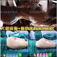 大腿吸脂+脂肪丰臀案例对比