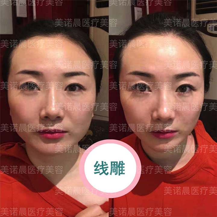 成都美诺晨线雕提升项目