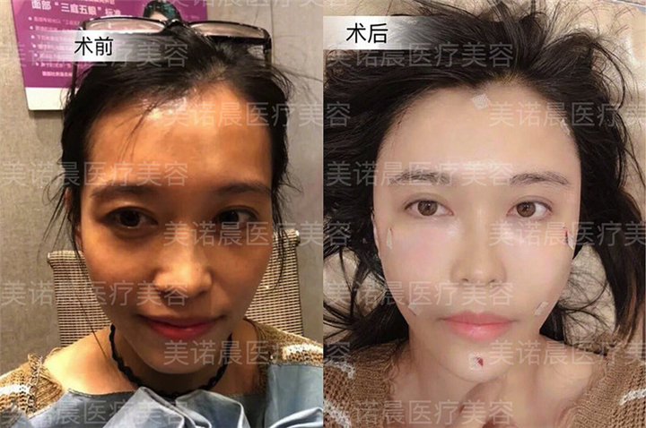 成都做面部脂肪填充的哪家好