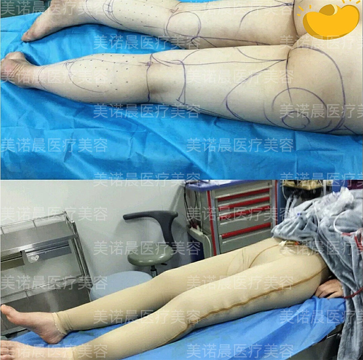 成都美诺晨大腿抽脂整形