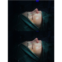 成都美诺晨肋骨鼻整形