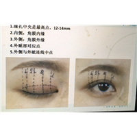 张彩云做双眼皮怎么样