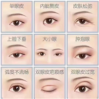 张彩云做双眼皮