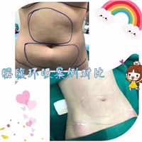 腰腹环吸案例对比