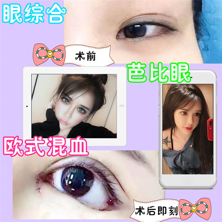 上海欧式混血芭比眼整形术后即刻