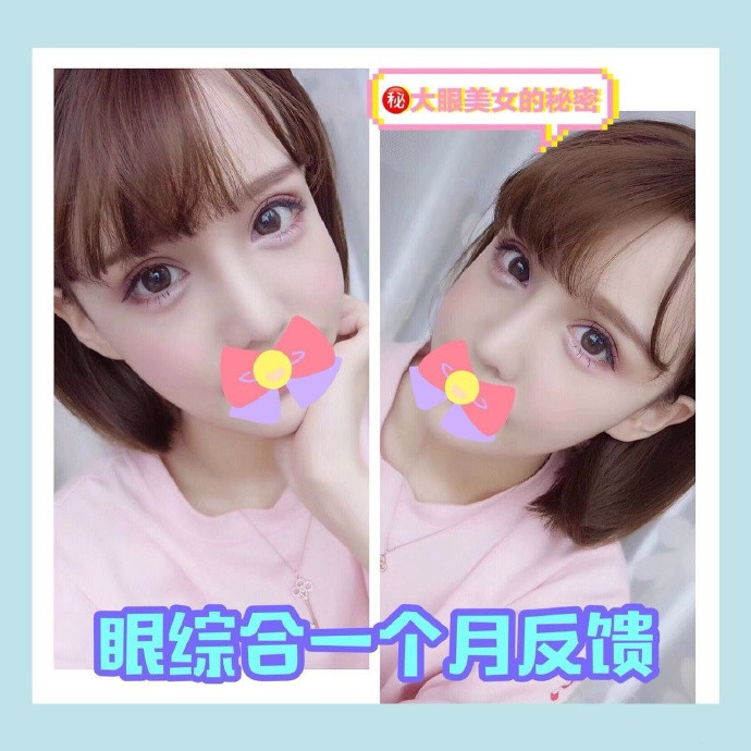 上海星璨整形 眼综合术后一个月反馈 
