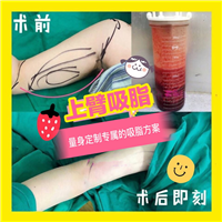 手臂吸脂案例@上海手臂吸脂价格