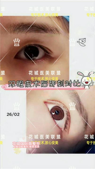 上海混血芭比眼整形、上海眼部整形修复