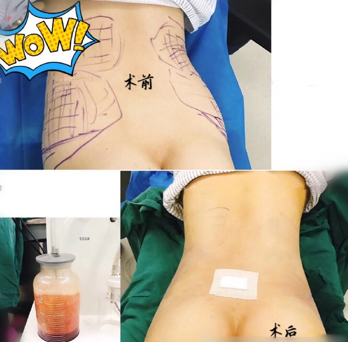 上海星璨国际整形 腰腹环吸术后即刻 