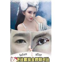 上海芭比混血眼综合整形 术后即刻