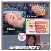 上海脂肪填充 