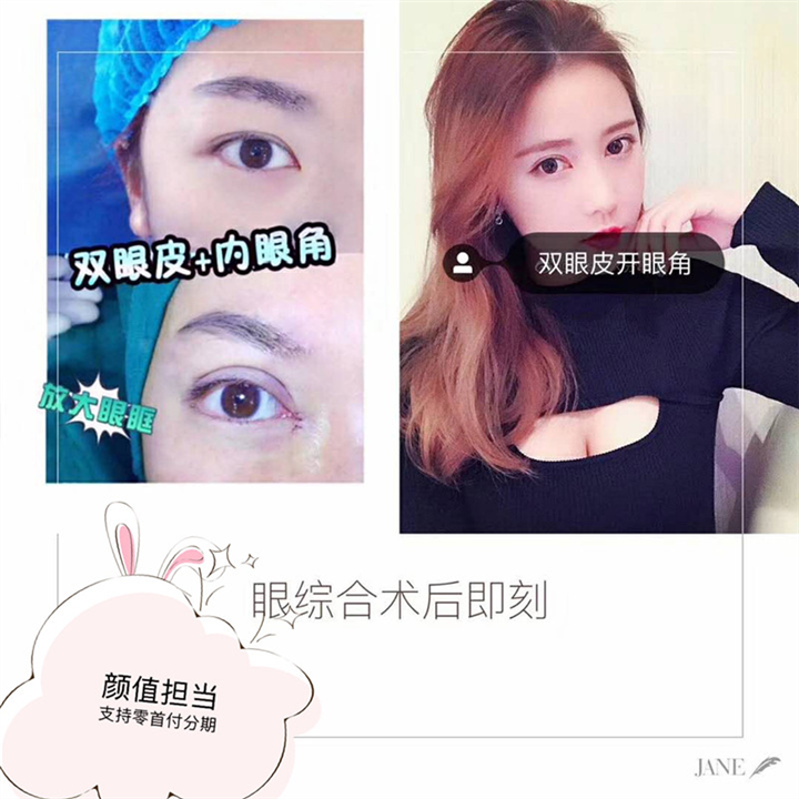 上海双眼皮整形修复医院哪家好？