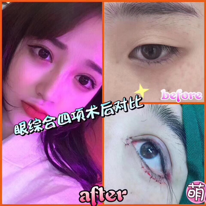 上海眼综合哪家做的好@上海专业网红整形