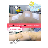 腰腹+提臀线吸脂+自体脂肪丰臀对比