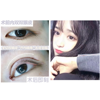 上海眼综合整形 术后即刻效果
